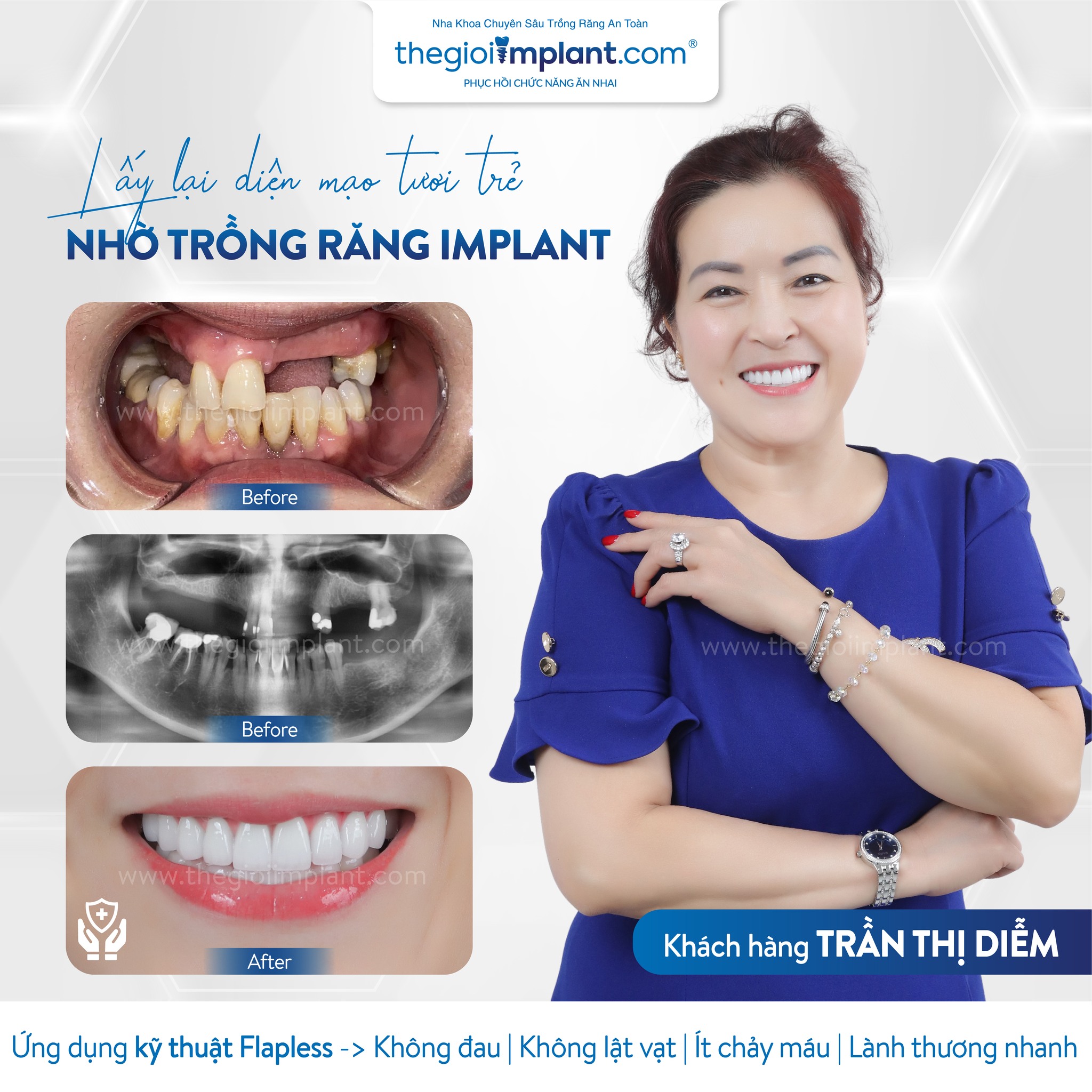 Implant patient at Theimplantworld.com