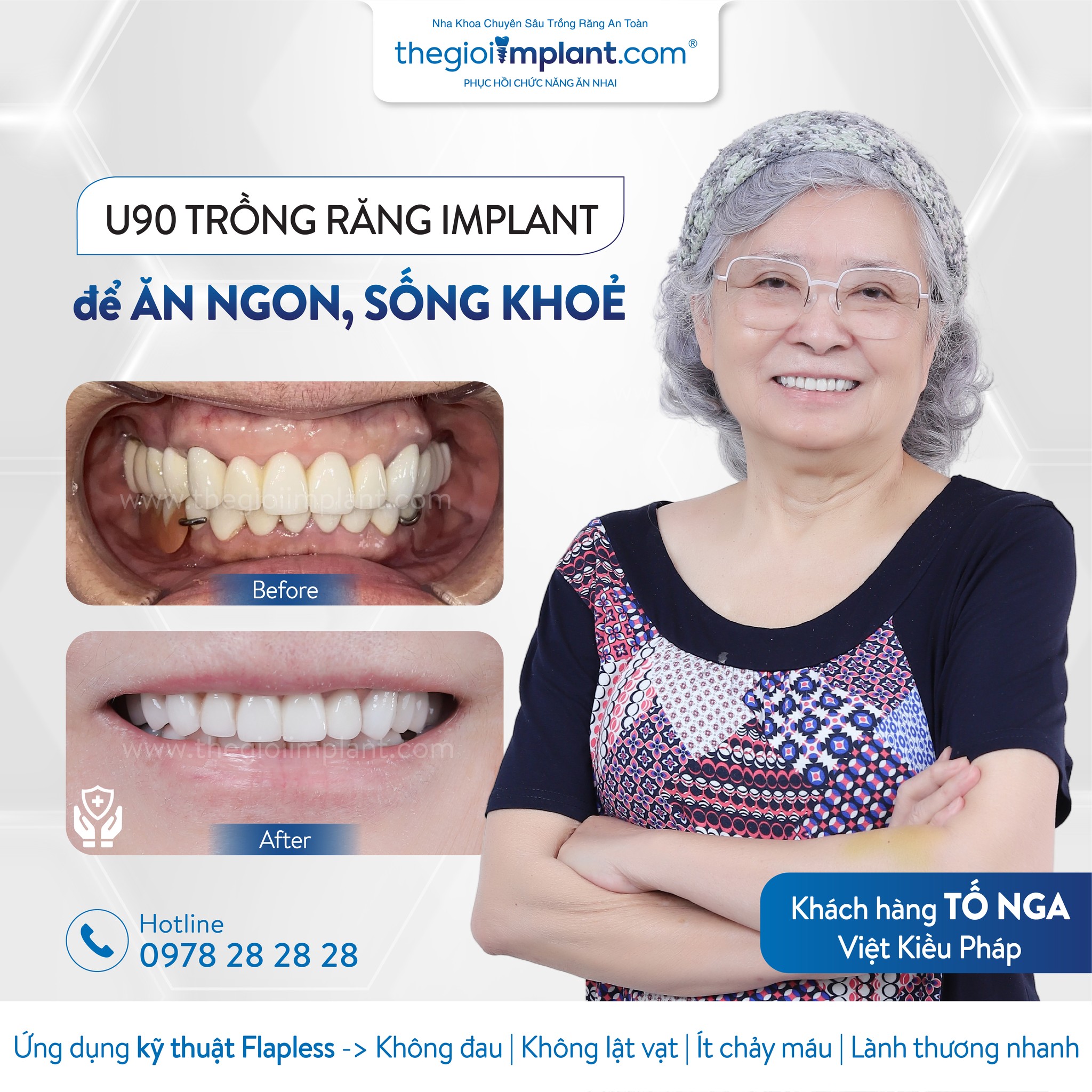 Implant patient at Thegioiimplant.com