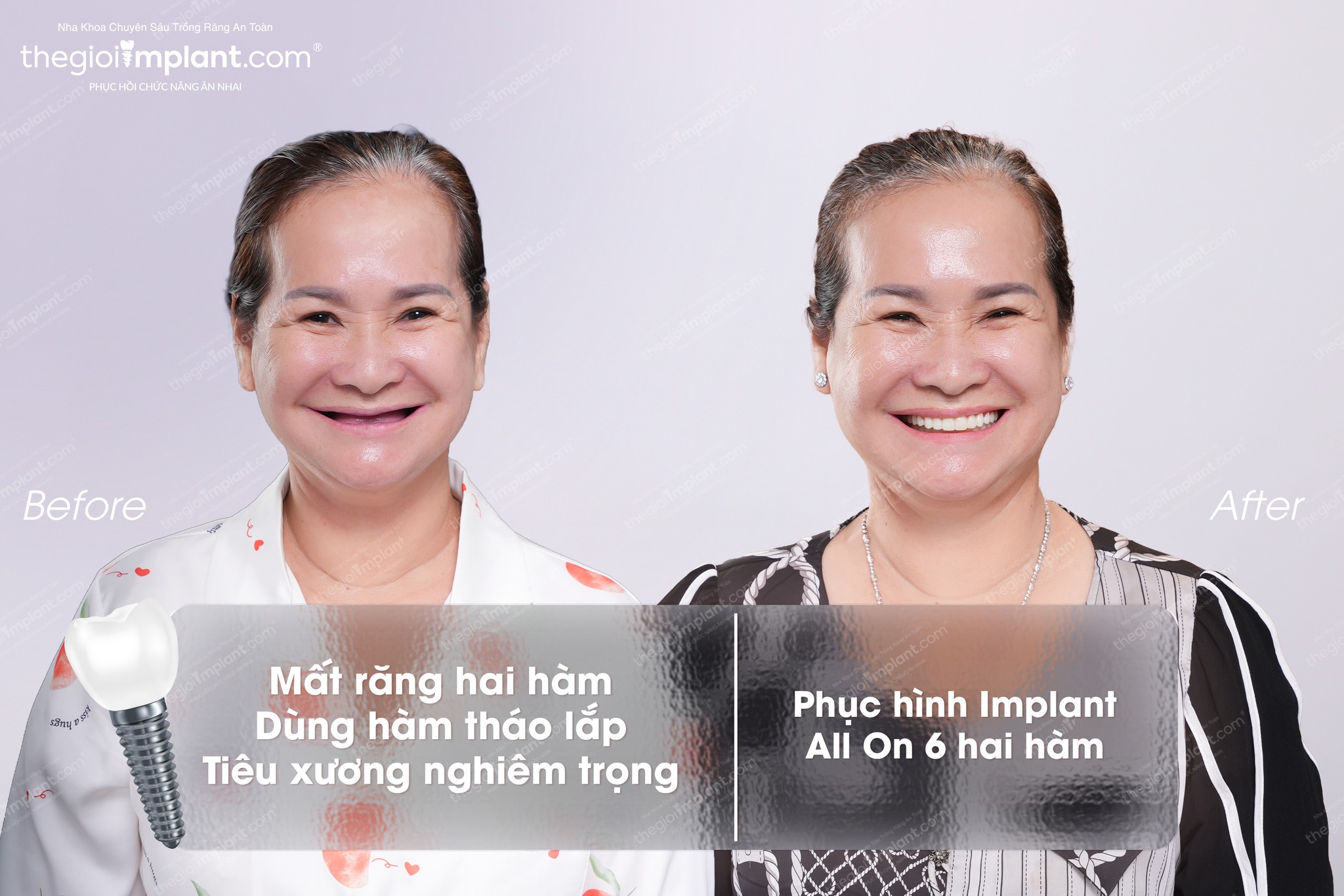 Implant patient at Thegioiimplant.com