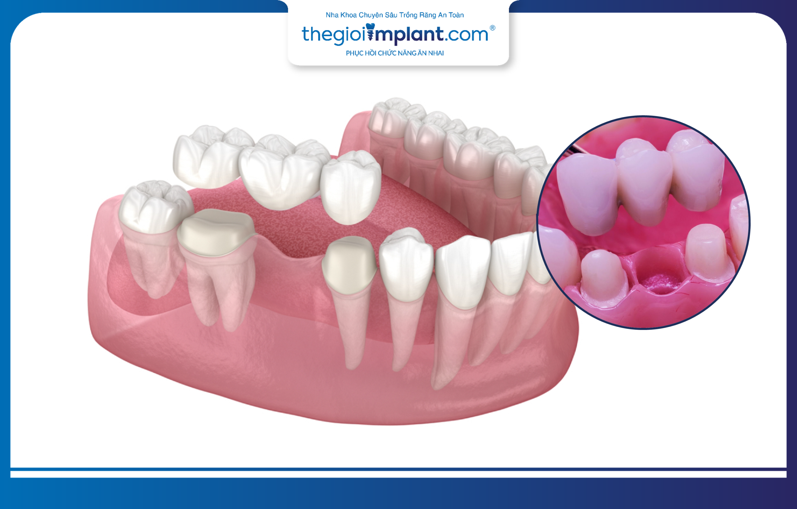 A dental bridge restoring a single missing tooth
