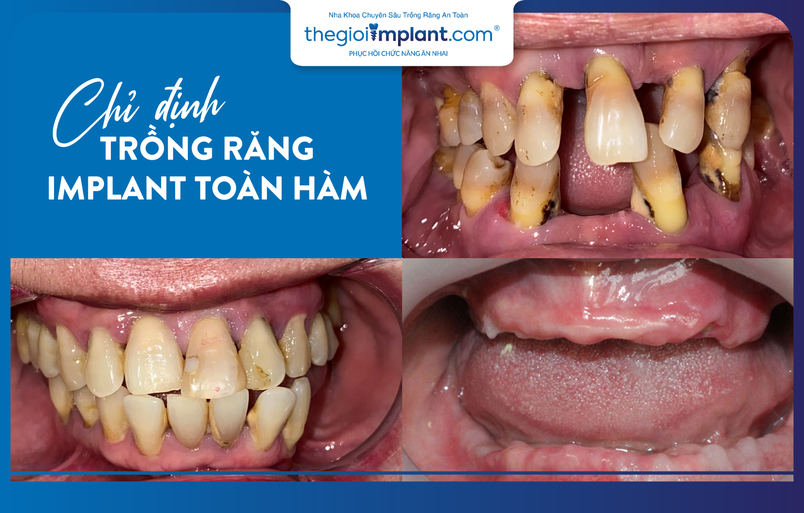 Indications for full-arch dental implants