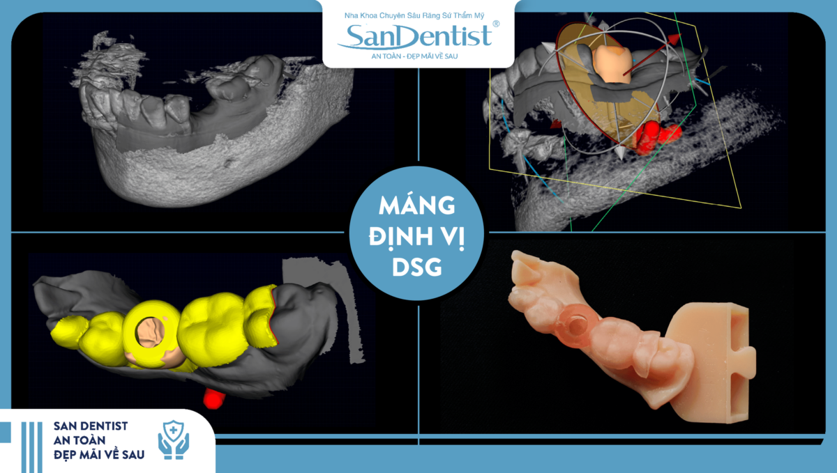 The DSG surgical guide used in the dental implant procedure