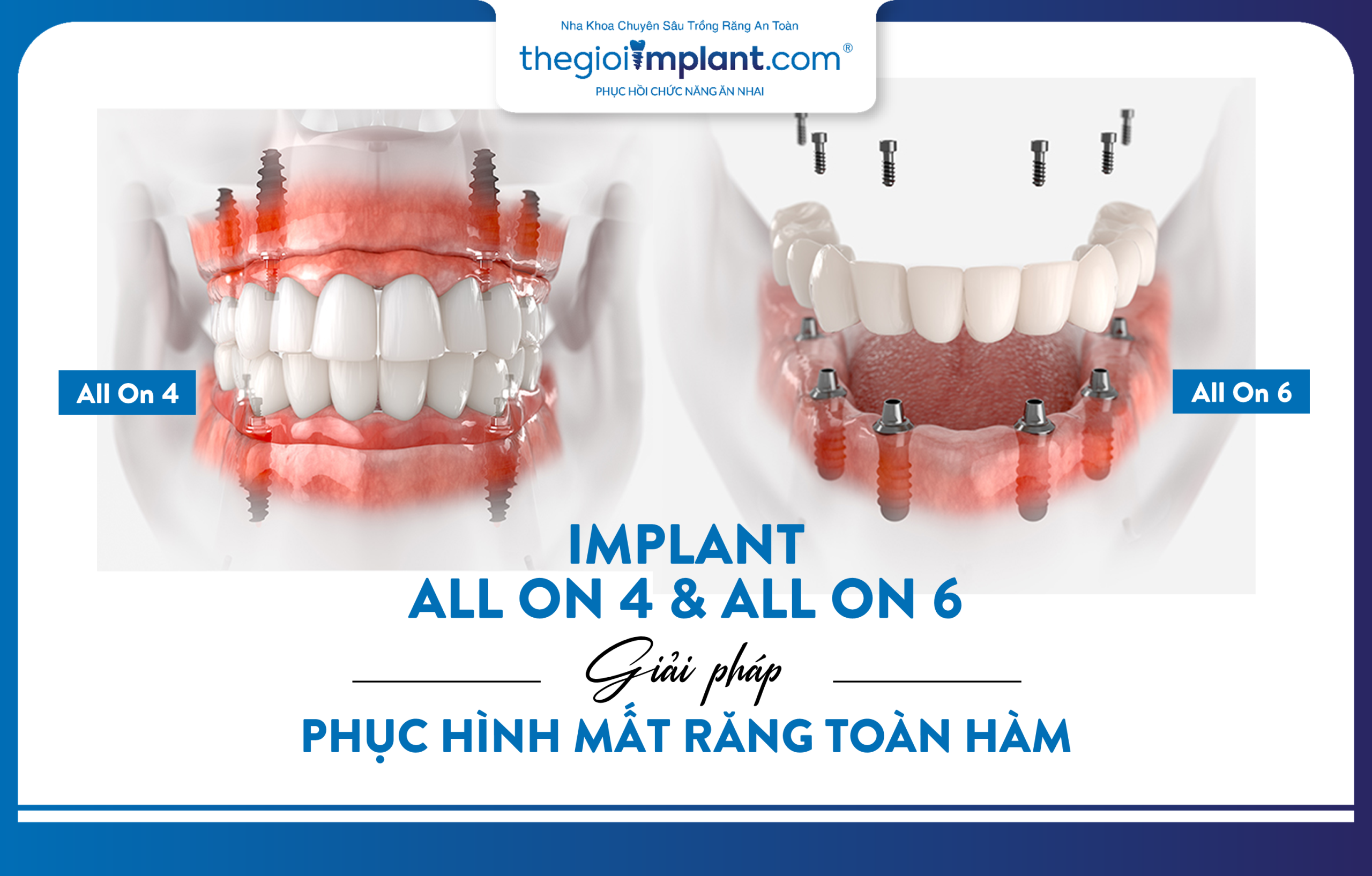 All-on-4 and All-on-6 Dental Implants - restorative solutions for full-arch tooth loss