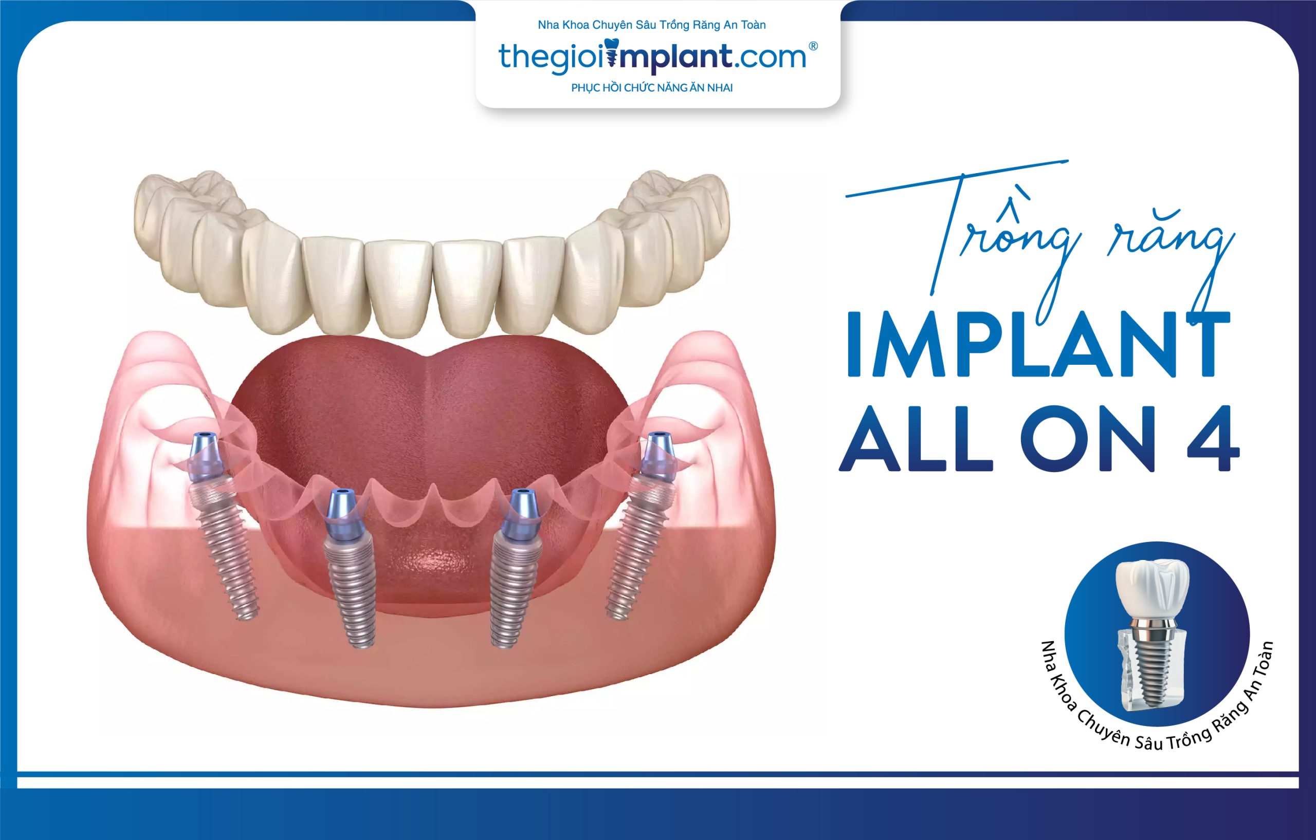The All-on-4 full-arch dental implant method