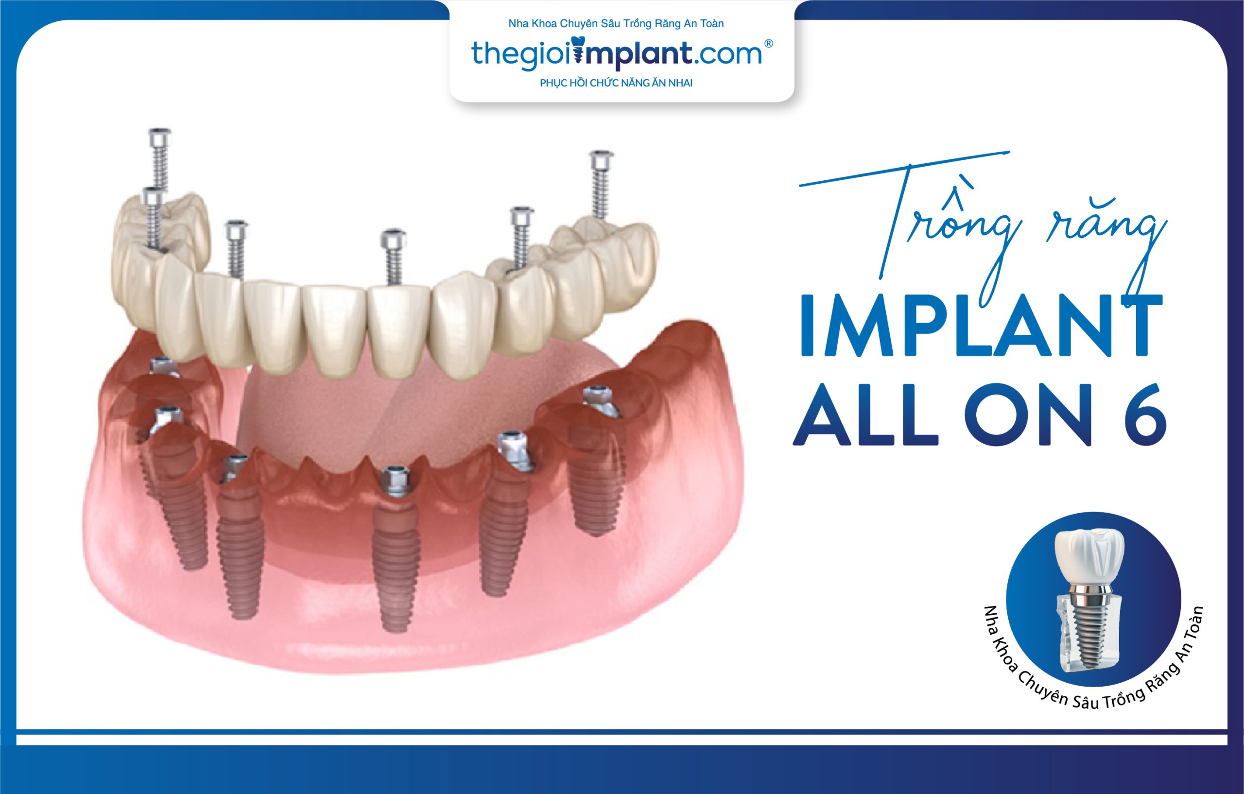 The All-on-6 full-arch dental implant method