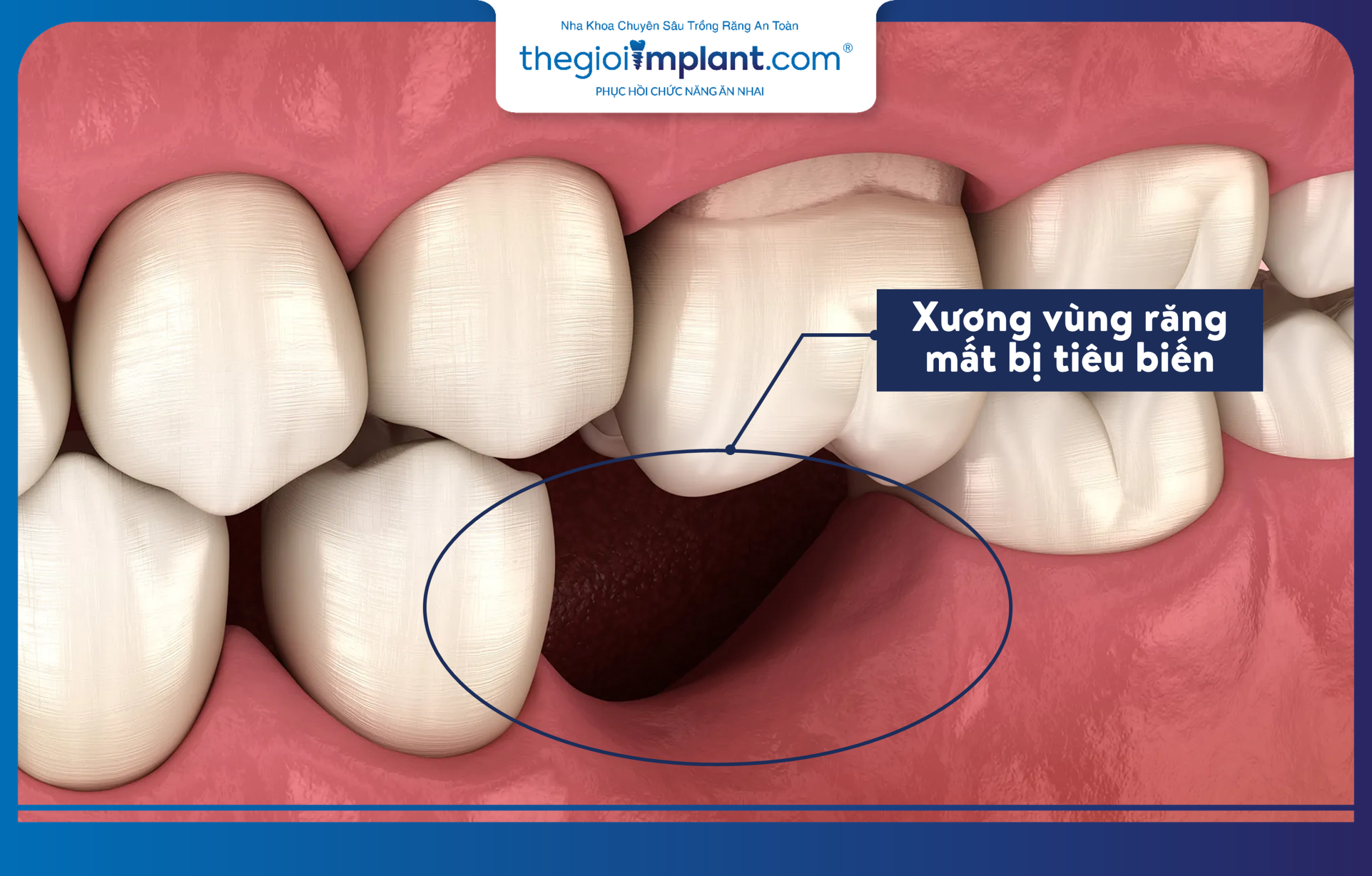The jawbone at the site of long-term missing teeth will gradually resorb