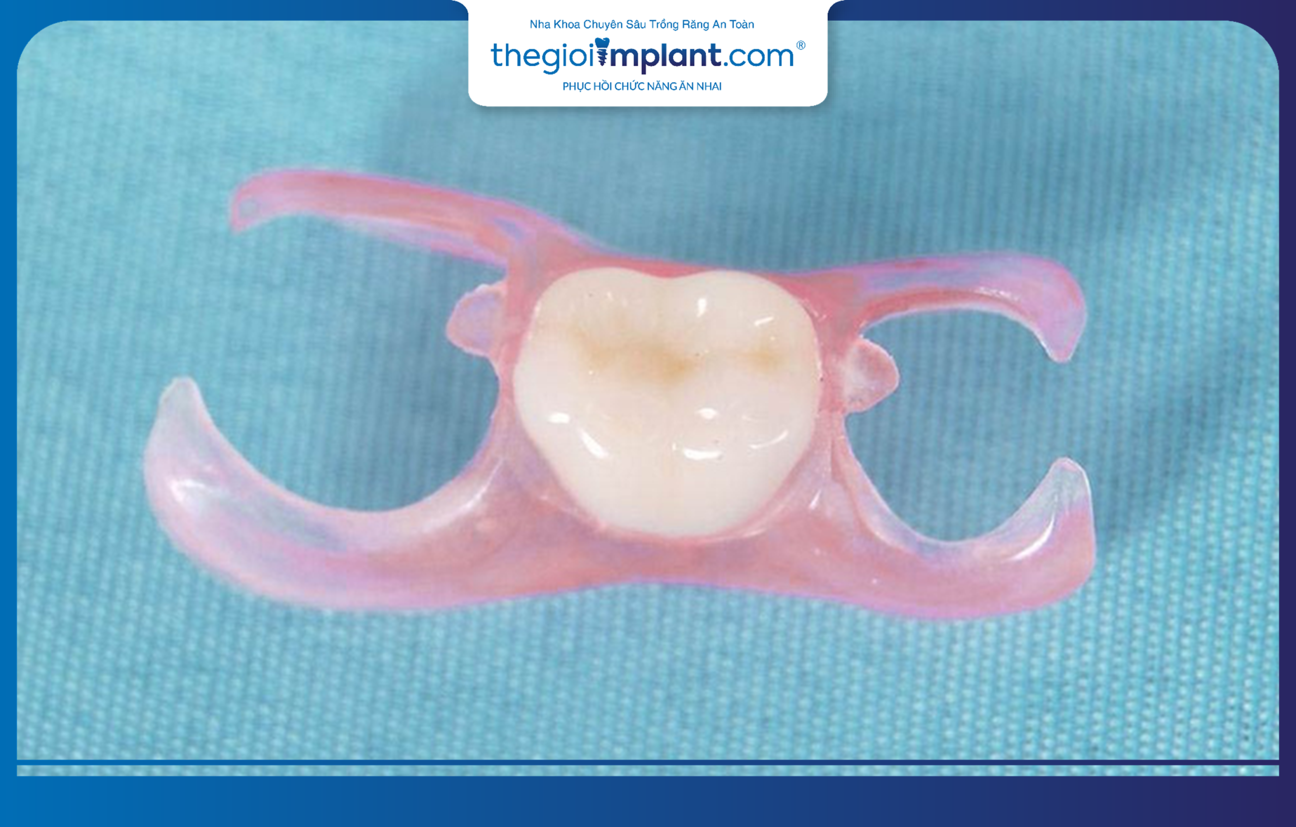 Single removable denture