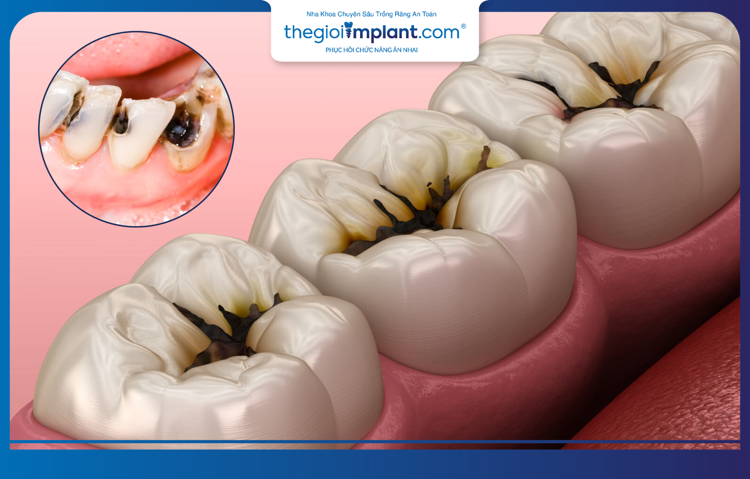 Untreated tooth decay leads to pulp necrosis and tooth loss