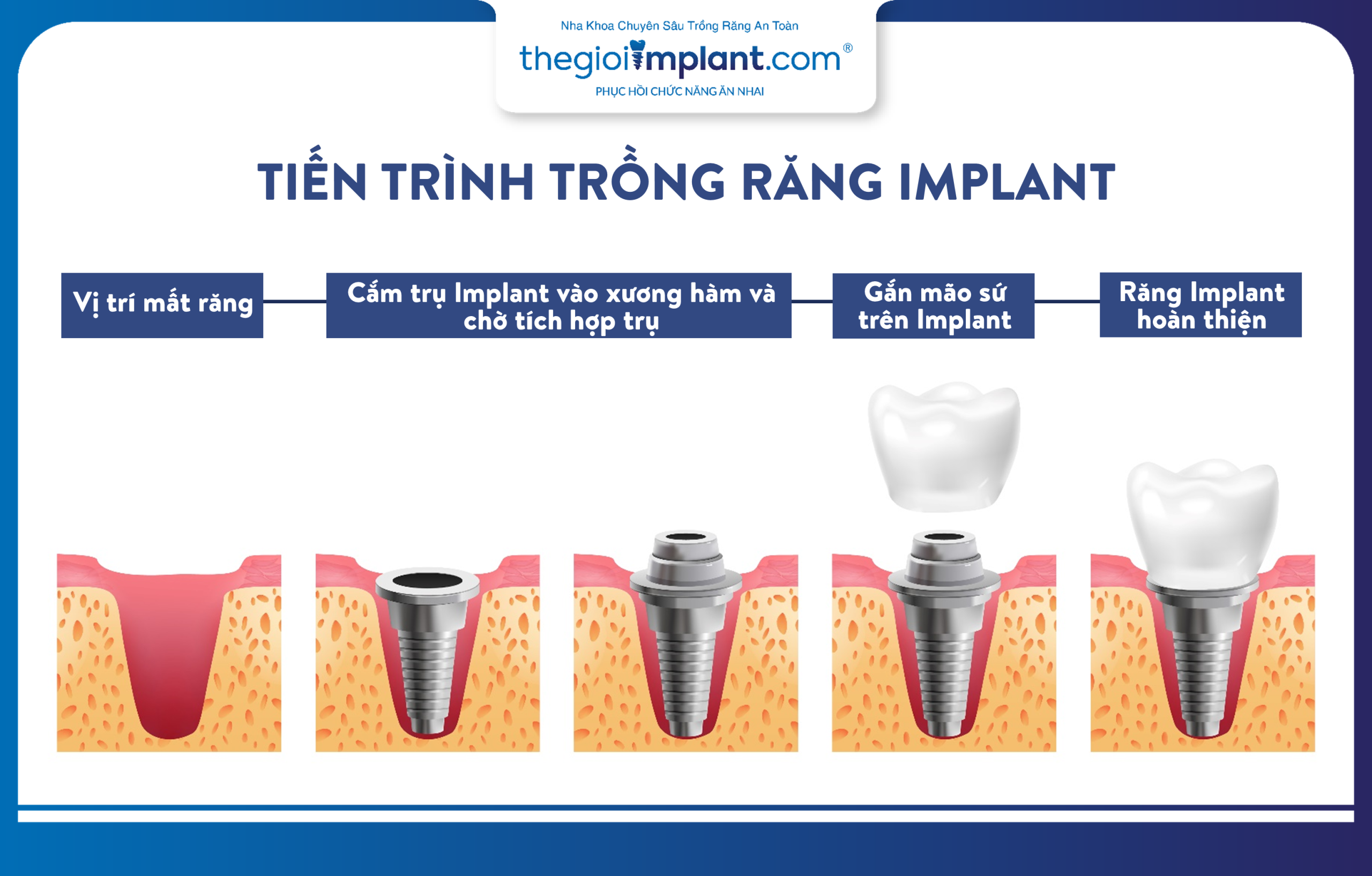 The progression of dental implant placement to restore missing teeth