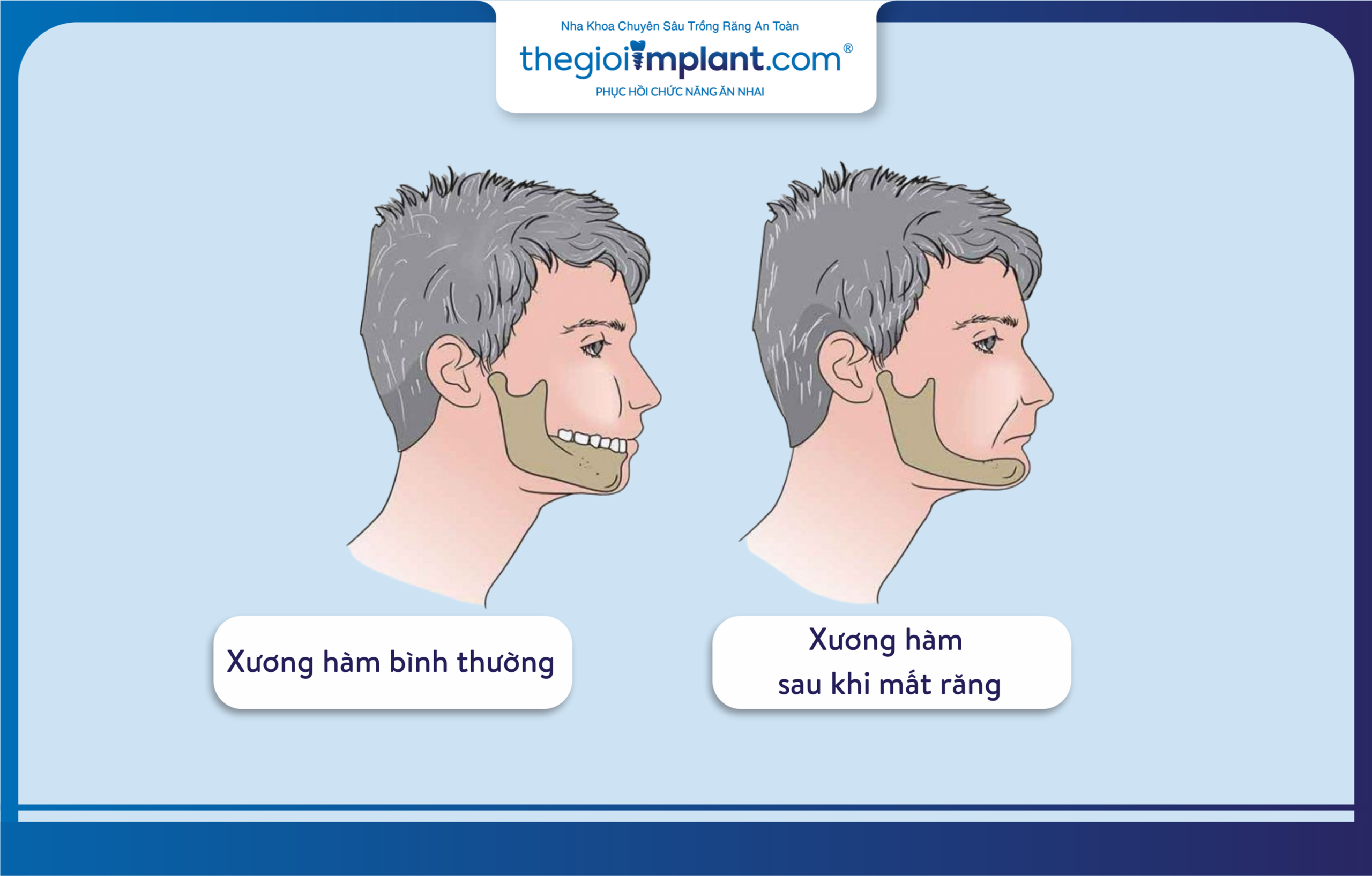 Jawbone resorption in cases of long-term tooth loss