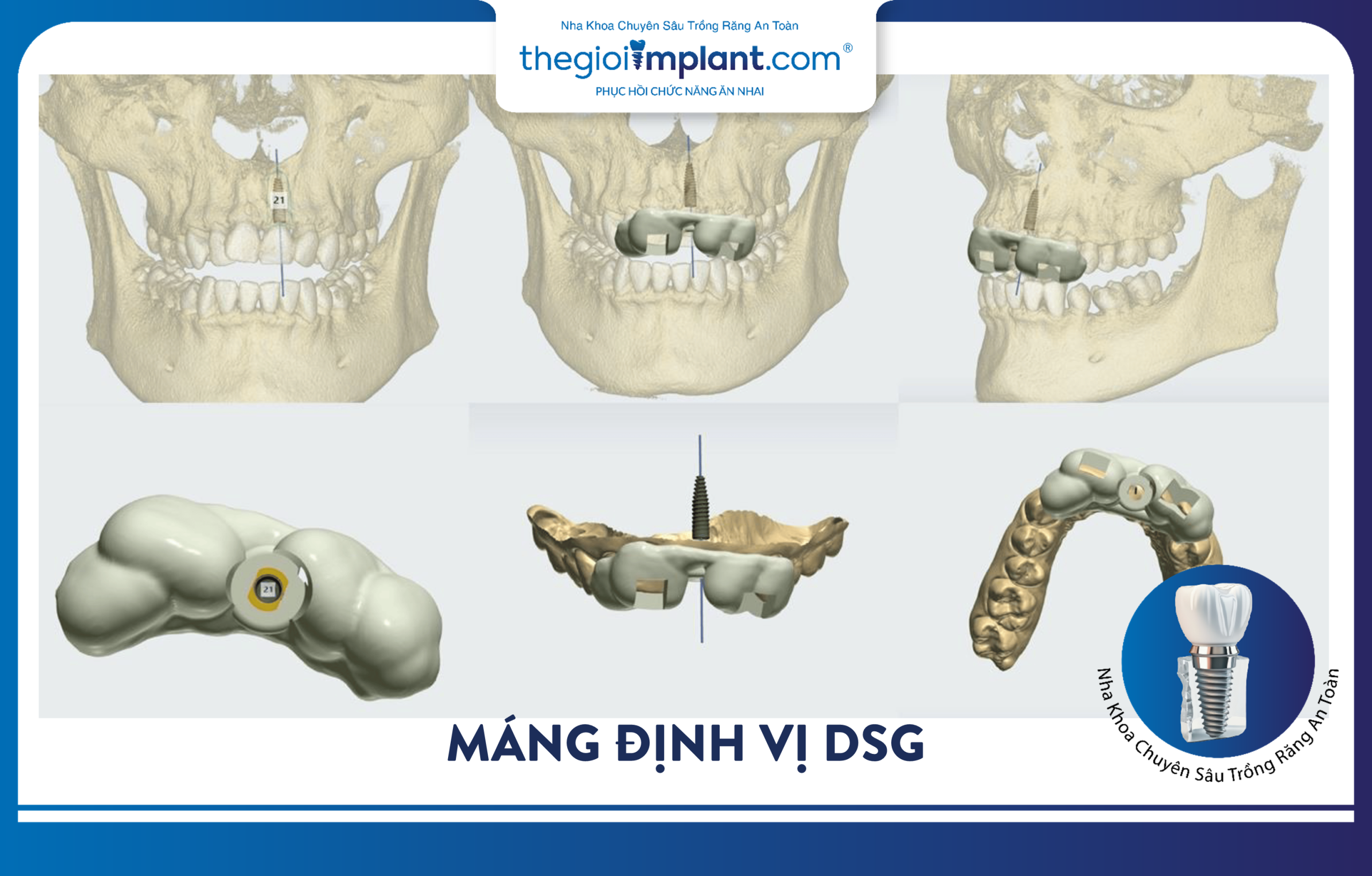 The DSG surgical guide used in the dental implant procedure