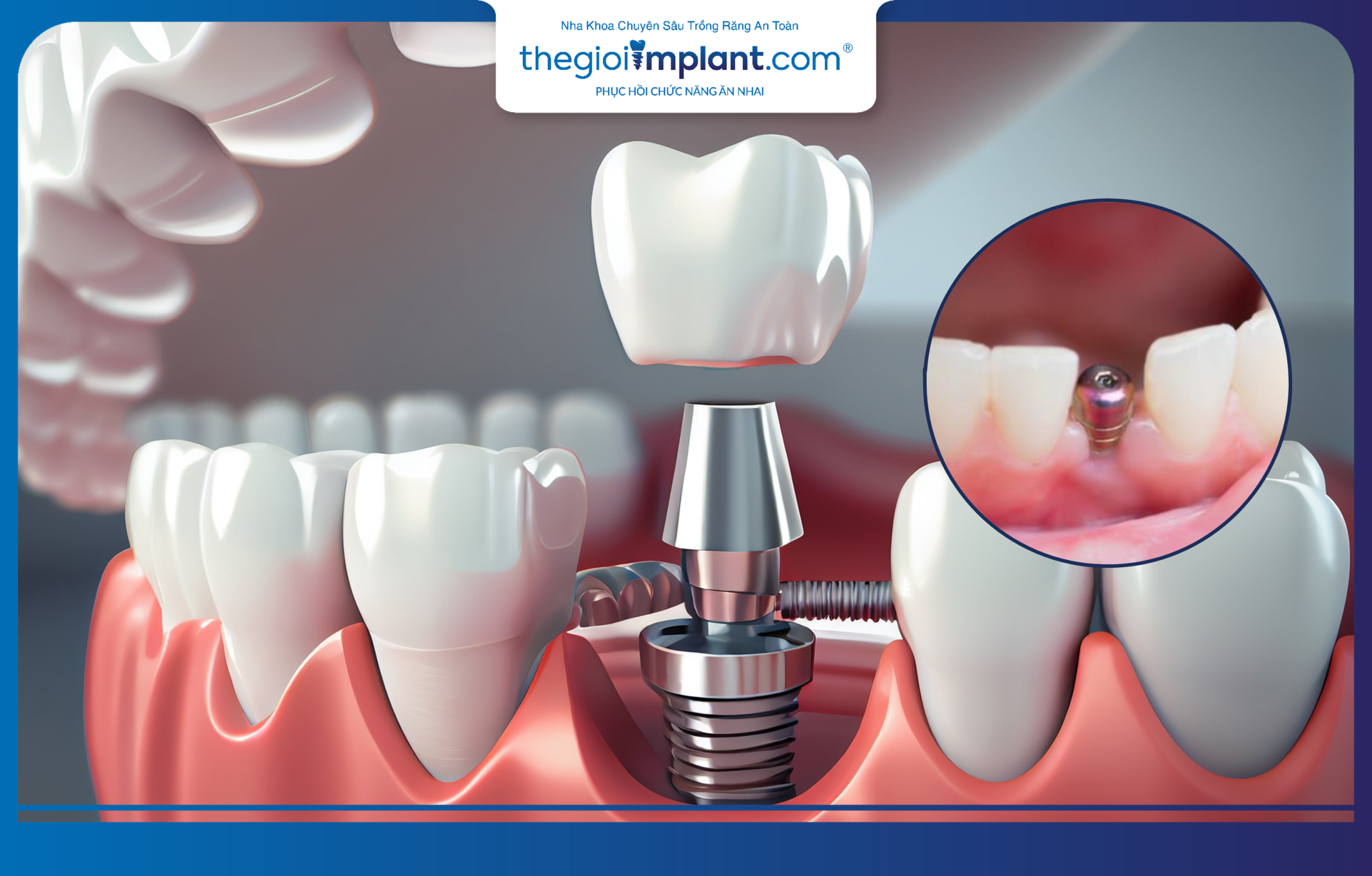 Dental implant placement provides optimal restoration for missing teeth