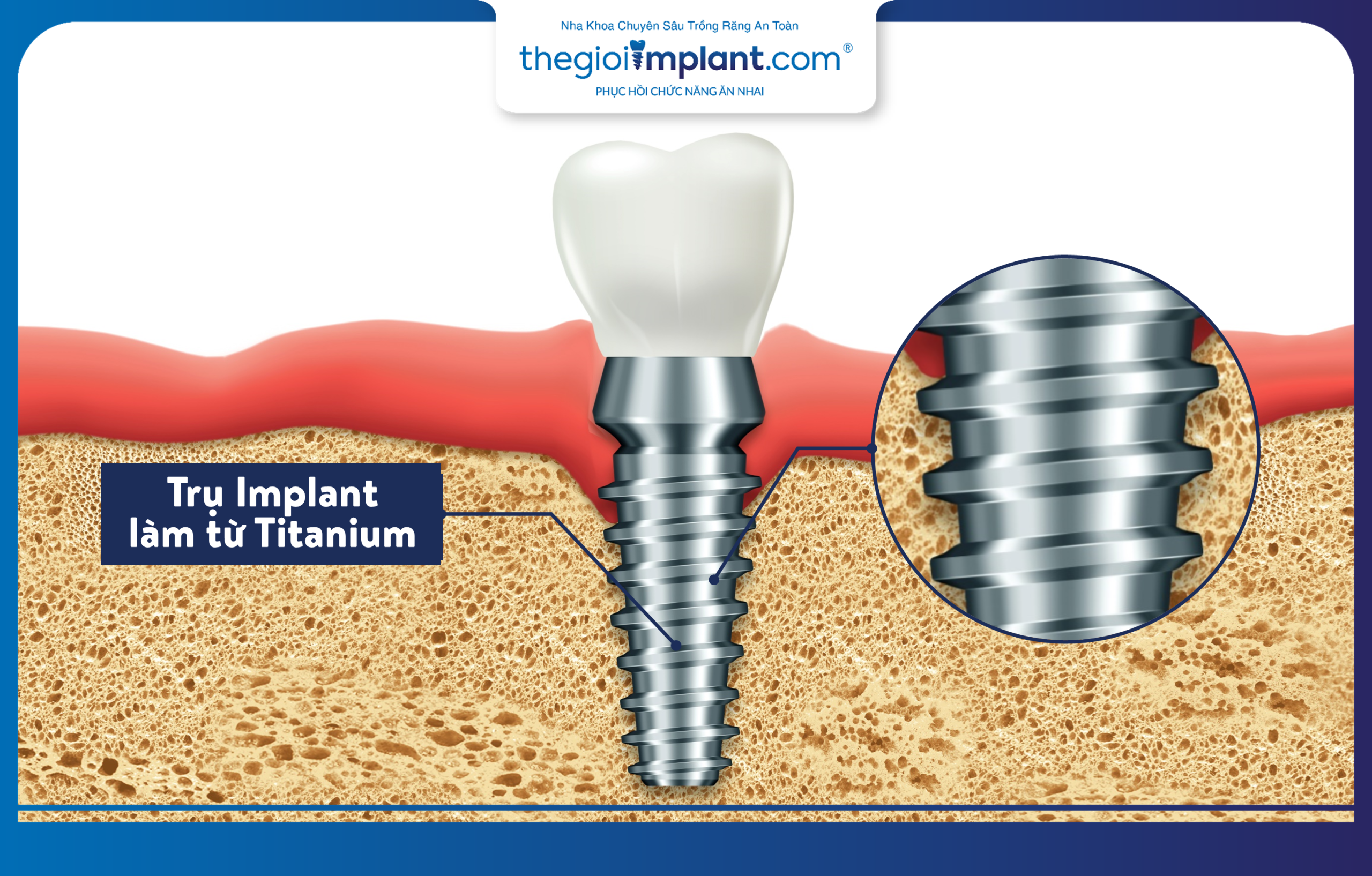 Titanium is the material used to fabricate implant posts, which is safe for the body