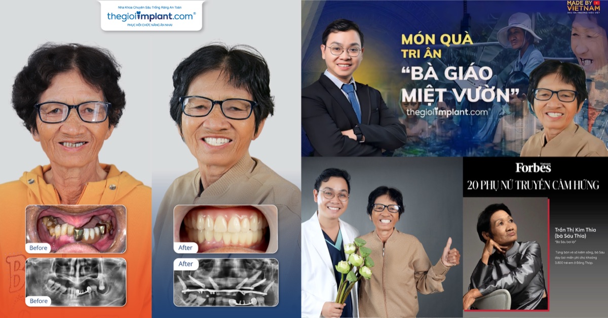 Ms. Sau Thia - Forbes 2021 Top 20 Inspiring Women, successful complex implant case with Dr. Vo Ta Dung