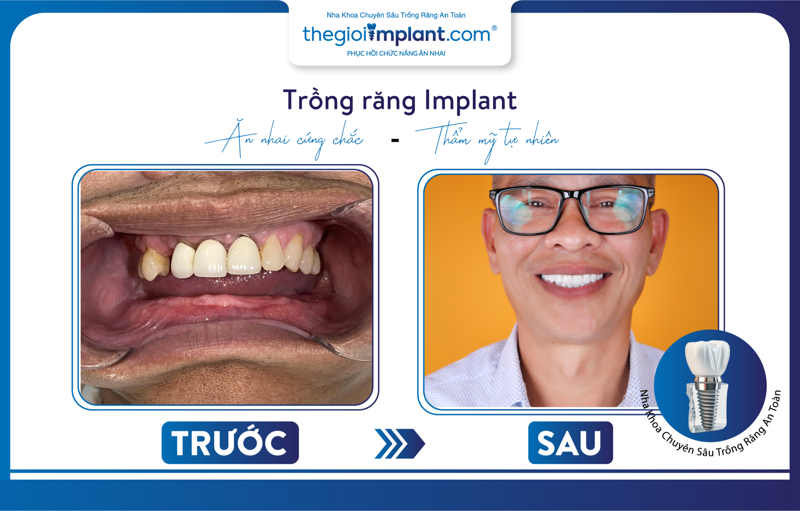 A client restoring missing teeth with dental implants at Thegioiimplant
