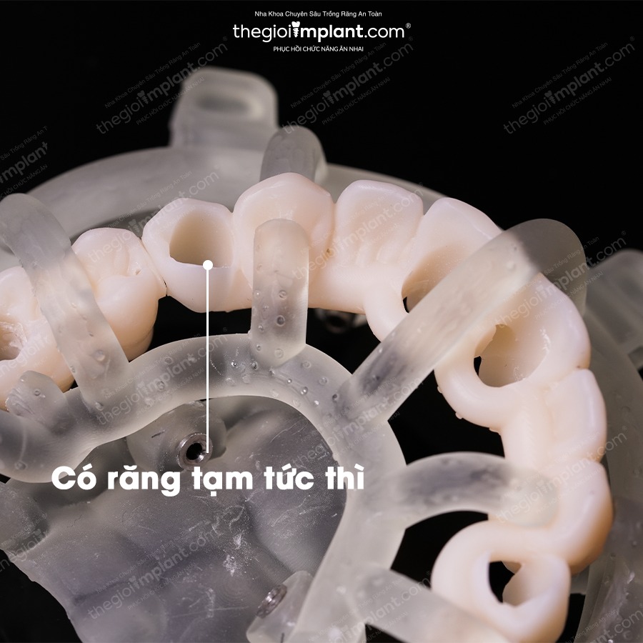 5-minute placement per implant