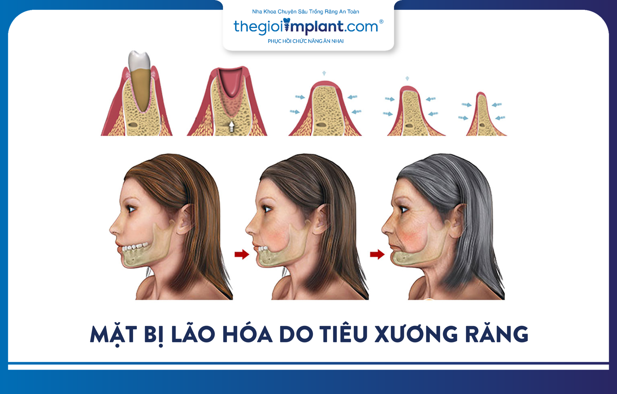 Jawbone resorption leads to facial aging