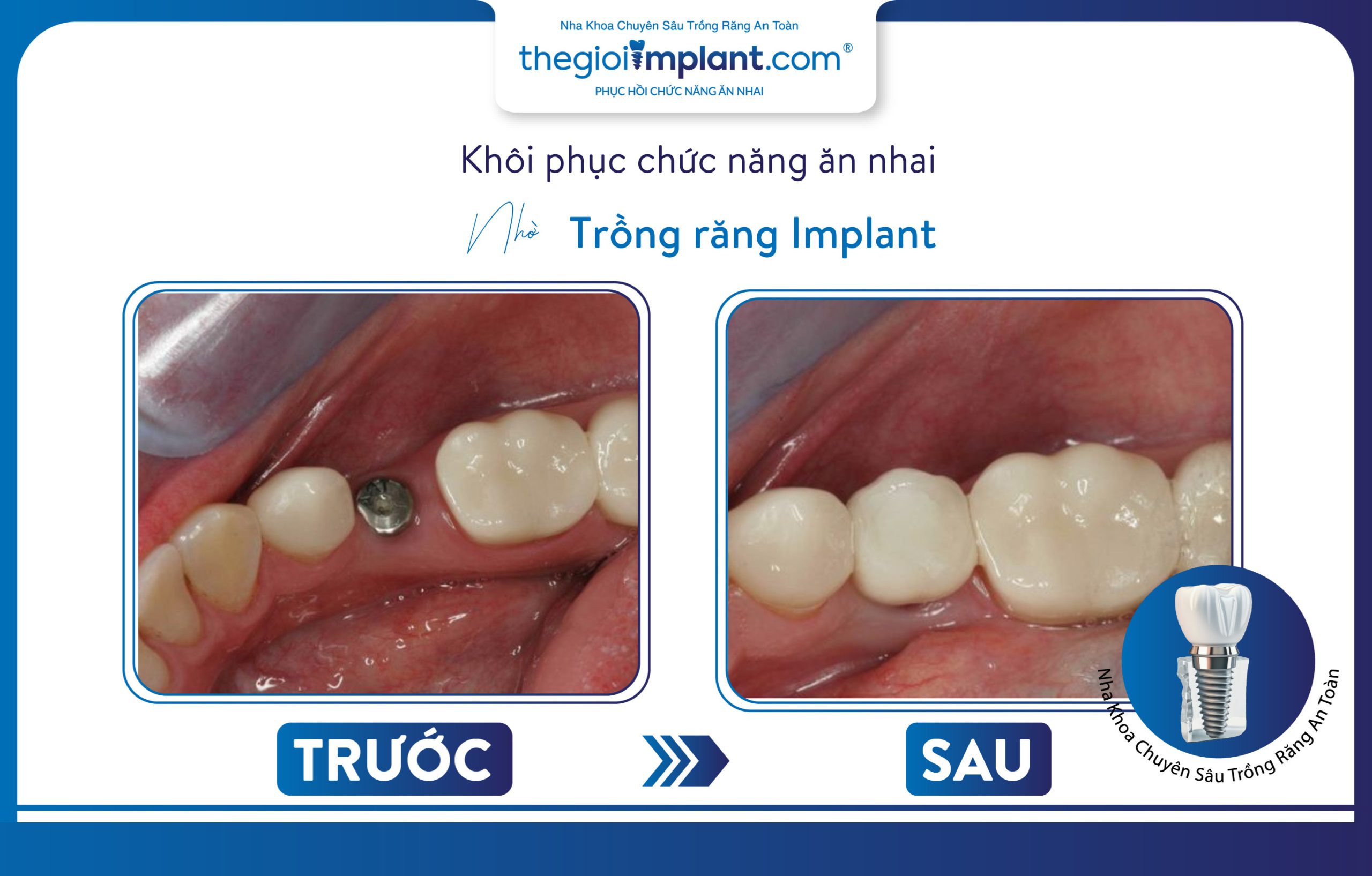 Dental implants are an effective solution for restoring missing teeth