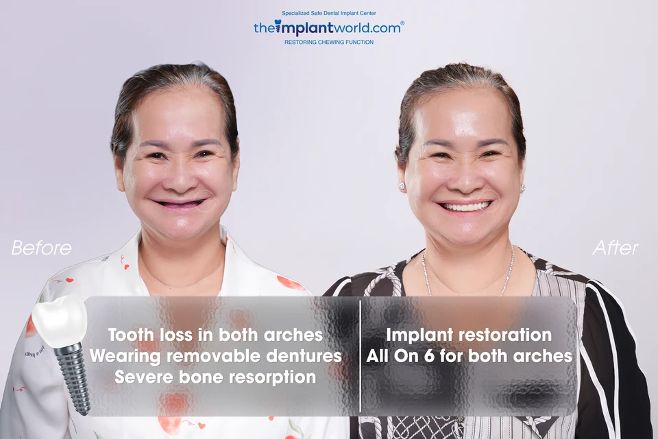 An elderly patient after an implant procedure with Dr. Vo Ta Dung