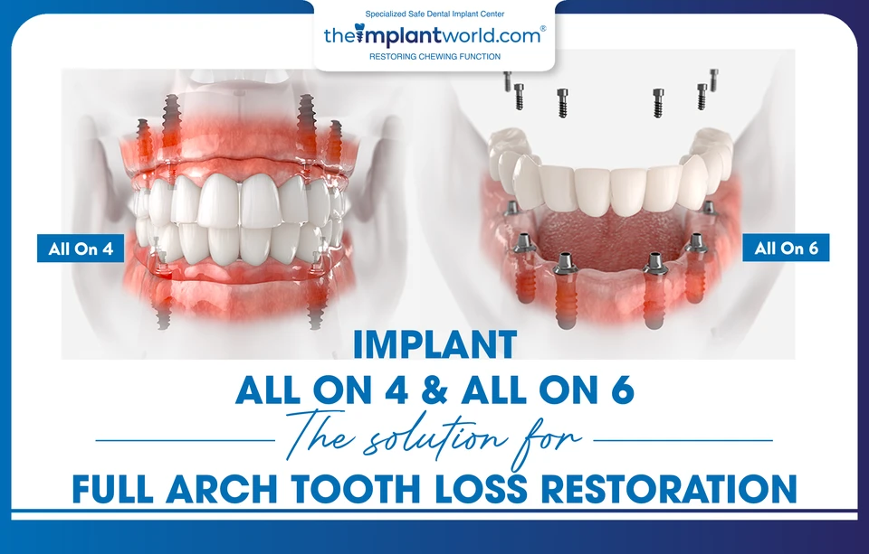 All-on-4 and All-on-6 Dental Implants - restorative solutions for full-arch tooth loss