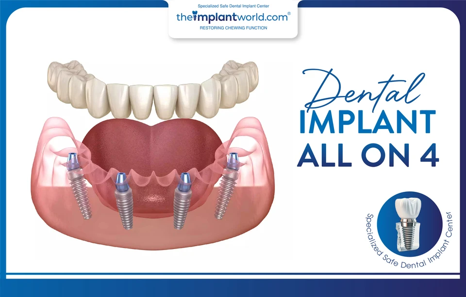 The All-on-4 full-arch dental implant method