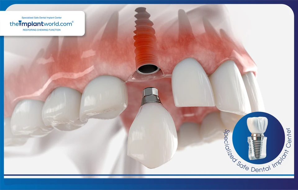 Replacing a single missing tooth with a dental implant