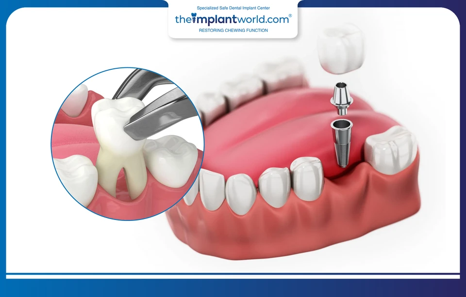 Dental implant placement and immediate restoration after tooth extraction
