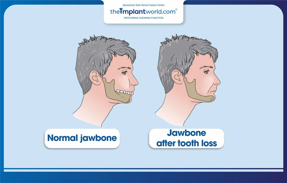 Jawbone resorption in cases of long-term tooth loss