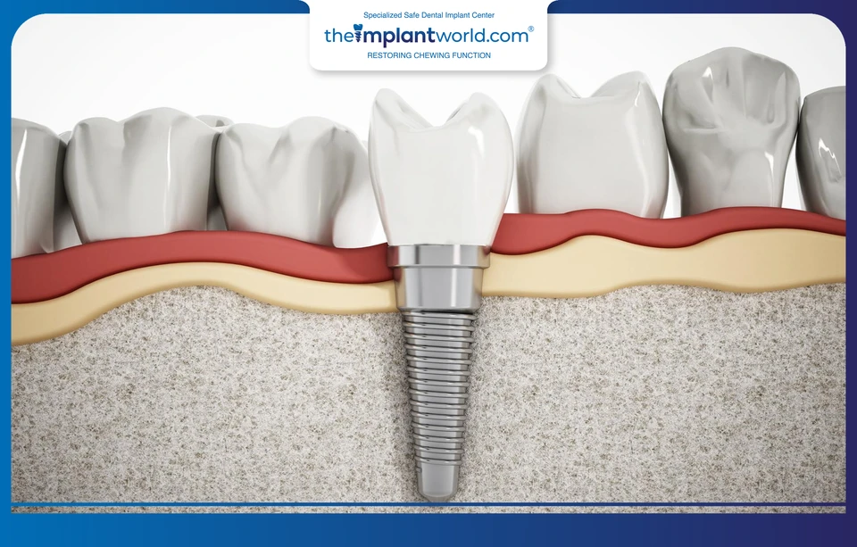 Implant-supported teeth after placement and immediate restoration
