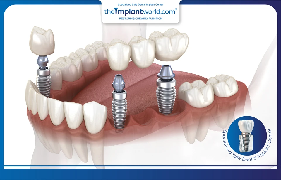Dental implants are the optimal solution for restoring multiple missing teeth