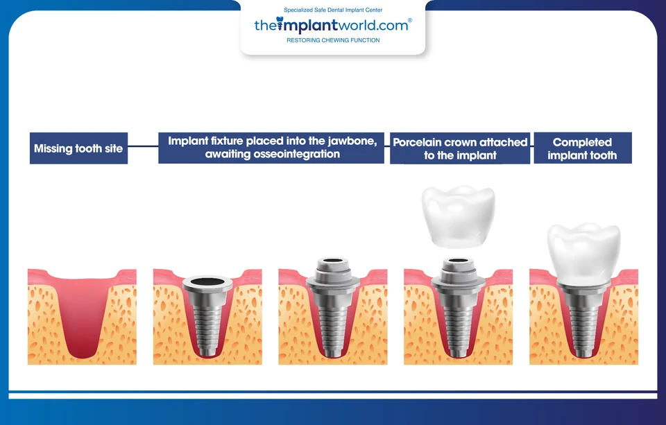 The progression of dental implant placement to restore missing teeth