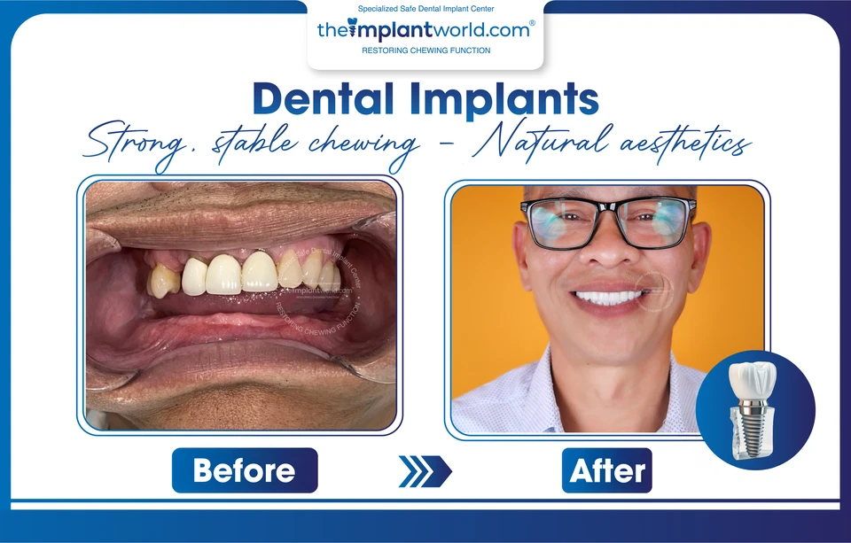 A client restoring missing teeth with dental implants at Thegioiimplant