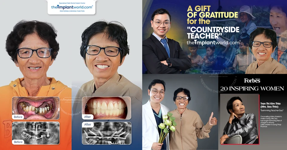 Ms. Sau Thia - Forbes 2021 Top 20 Inspiring Women, successful complex implant case with Dr. Vo Ta Dung