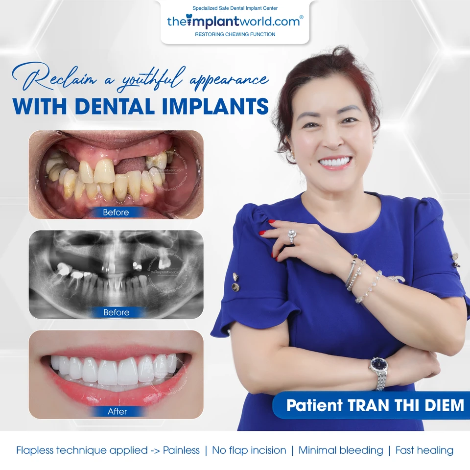 A patient after a dental implant procedure at Theimplantworld.com