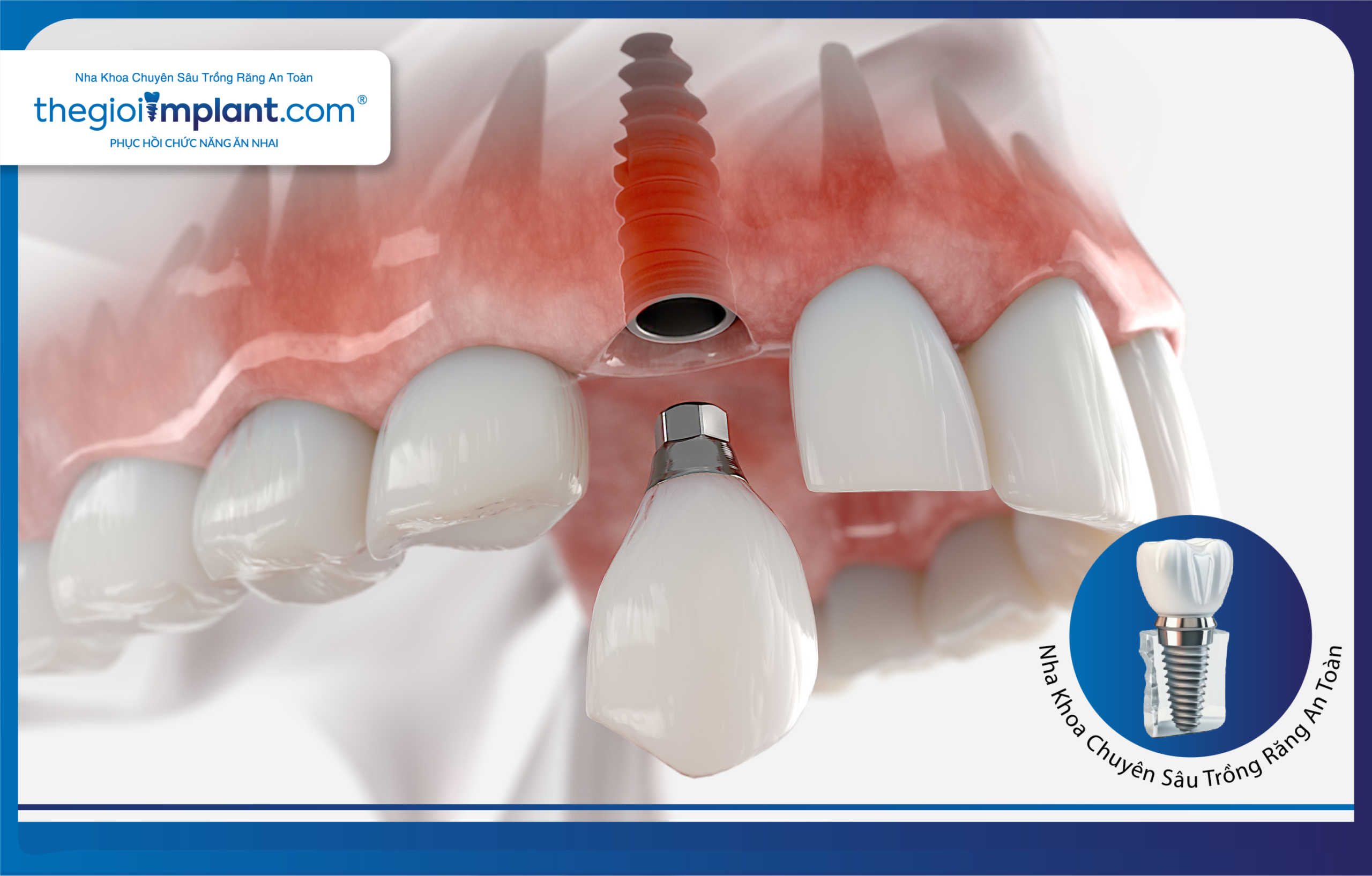 Replacing a single missing tooth with a dental implant