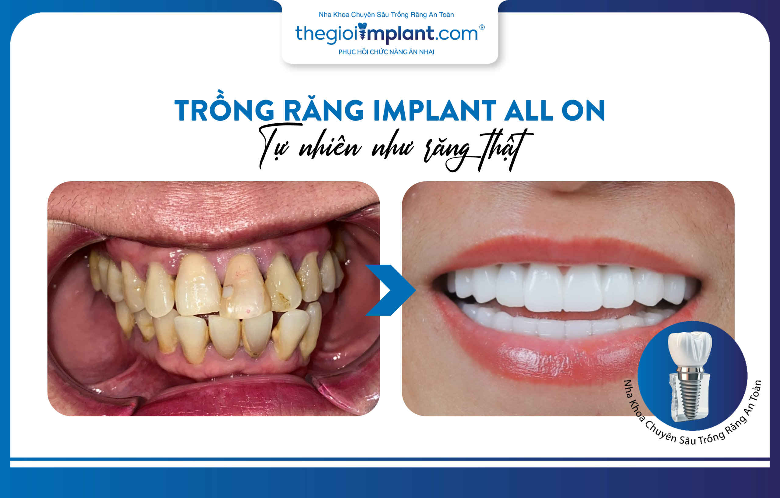 All-on full-arch dental implants: natural aesthetics like real teeth